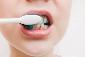 why-do-my-gums-bleed-when-i-brush-or-floss?-understanding-the-causes