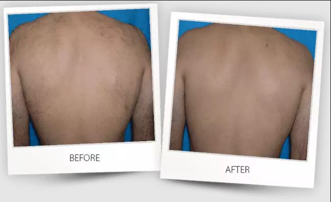 why-rochester-residents-are-saying-goodbye-to-razors-for-good